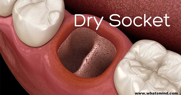When can I stop worrying about dry socket? 