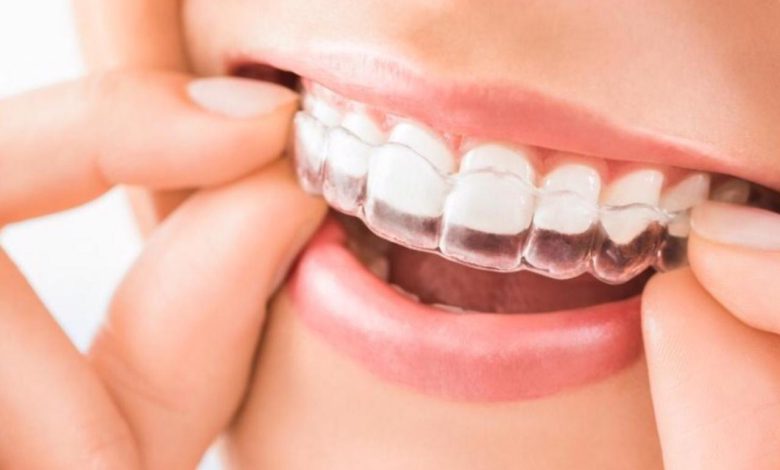 A Quick Guide on the Average Cost of Invisalign