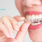 Invisalign vs Byte: Which Smile Solution Is Right for You?