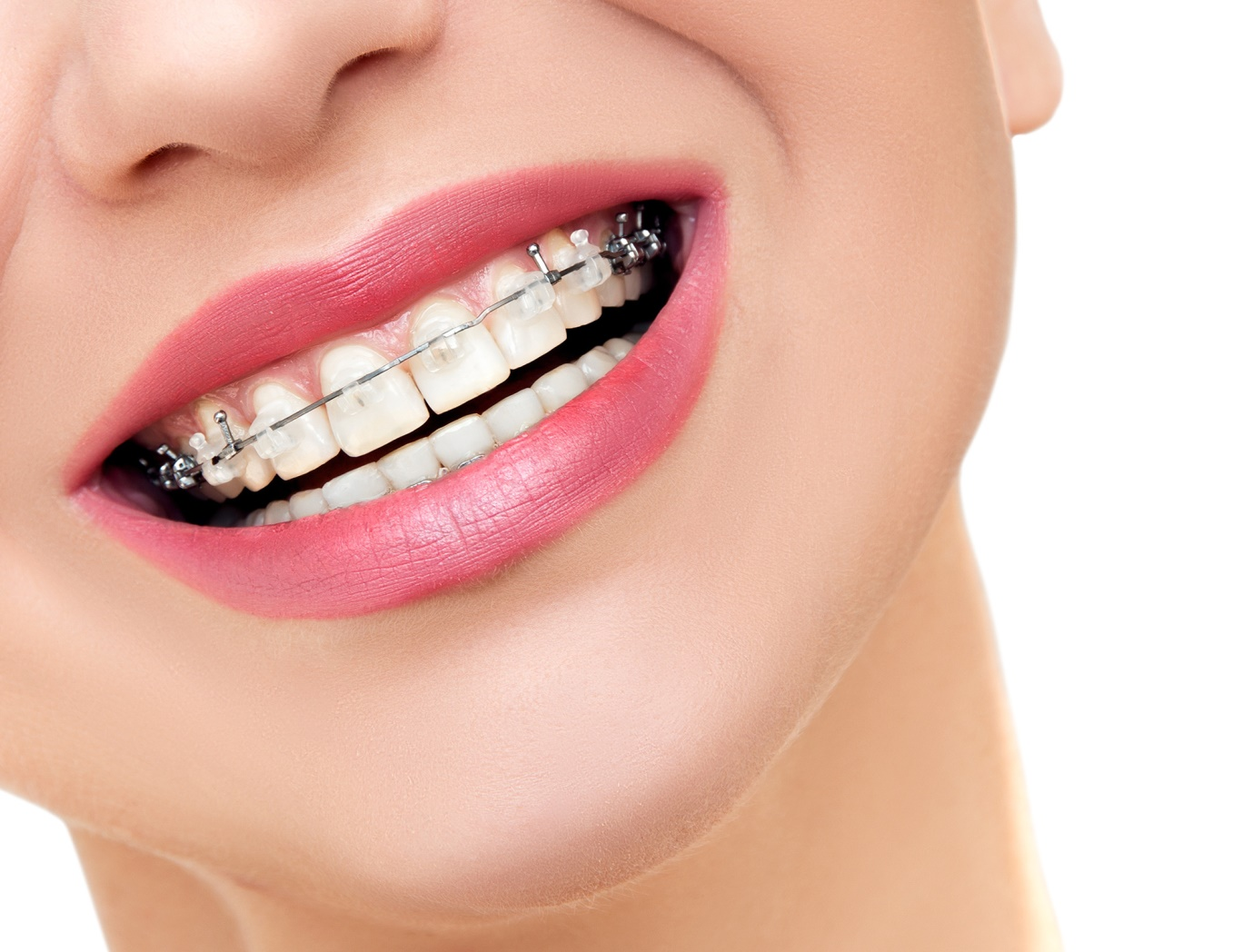 An Adult’s Guide to Getting Braces Later in Life