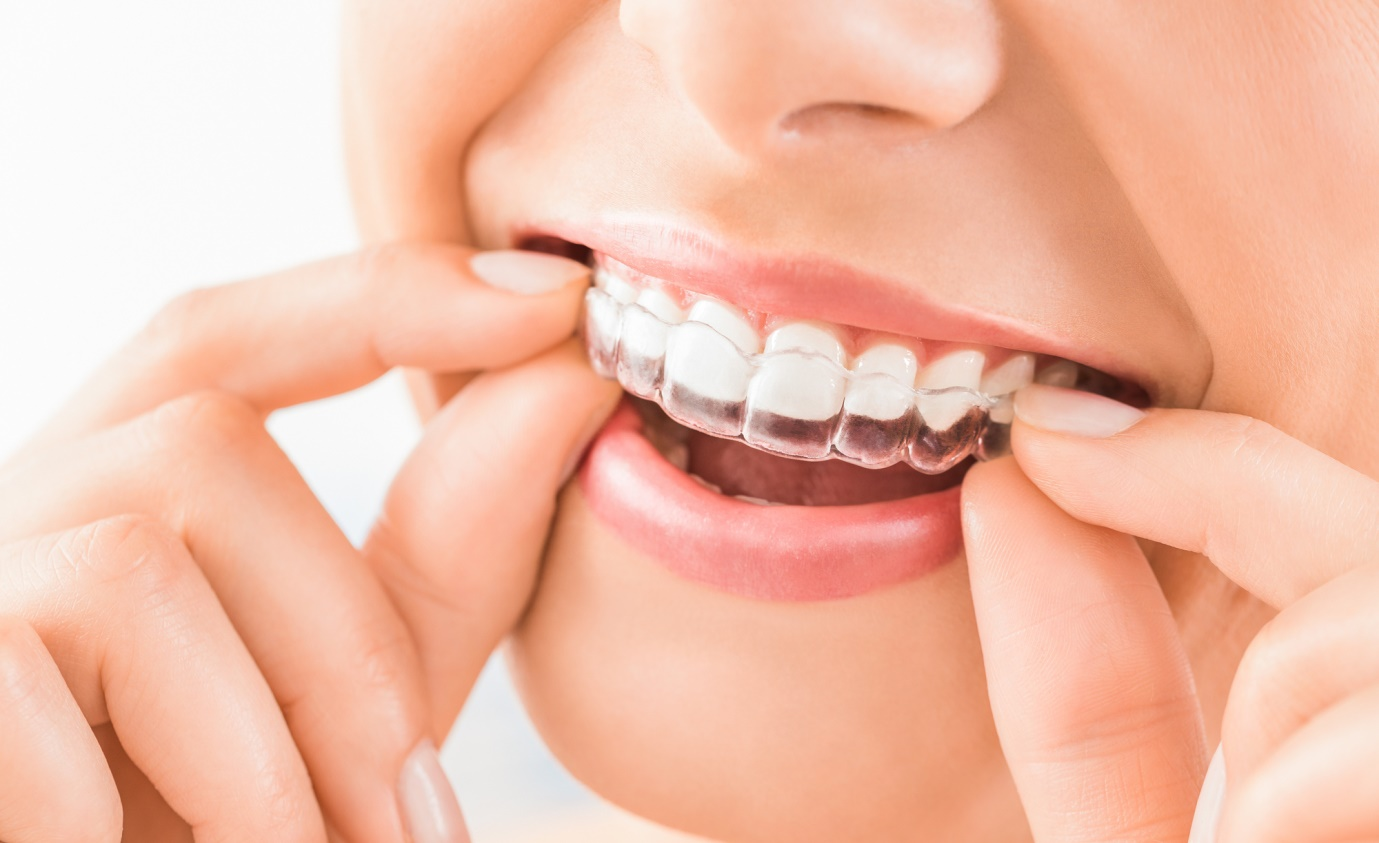Invisalign vs Byte: Which Smile Solution Is Right for You?