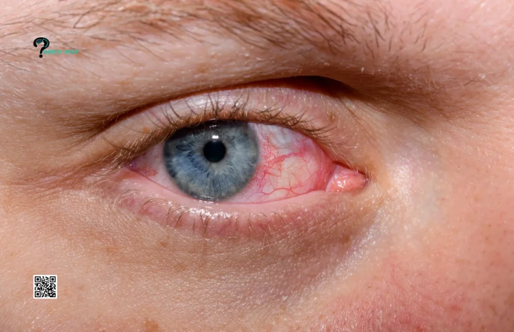 What Is Commonly Misdiagnosed As Pink Eye? Conjunctivitis, Myths, Preventive Measures & Doctor’s Consultation