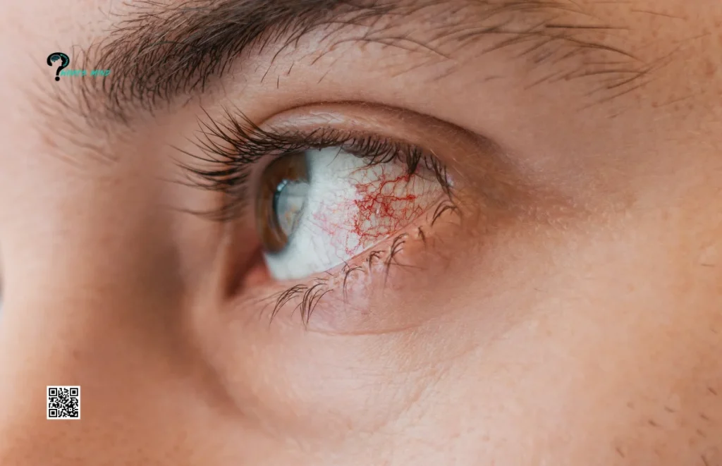 What Is Commonly Misdiagnosed As Pink Eye? Conjunctivitis, Myths, Preventive Measures & Doctor’s Consultation